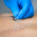 Close up of a needle and hands of physiotherapist doing a dry needling in a physiotherapy center.